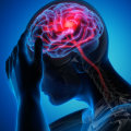 Headache: Understanding the Causes, Symptoms, and Treatments