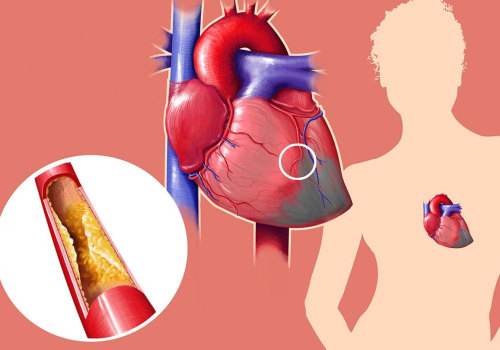 Understanding High Cholesterol and Its Causes